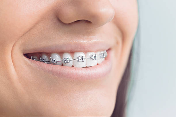 Dental Bonding in Tracy, CA